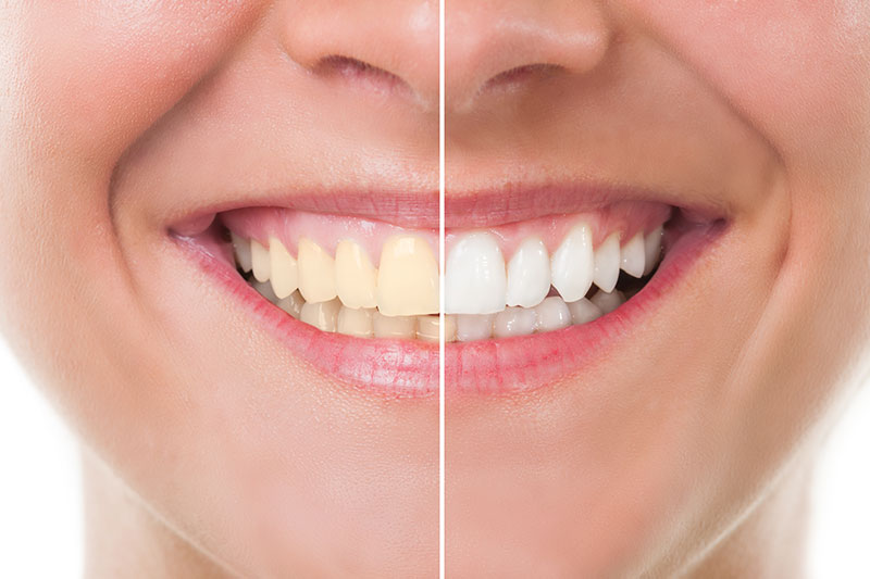 Teeth Whitening in Bridgeville